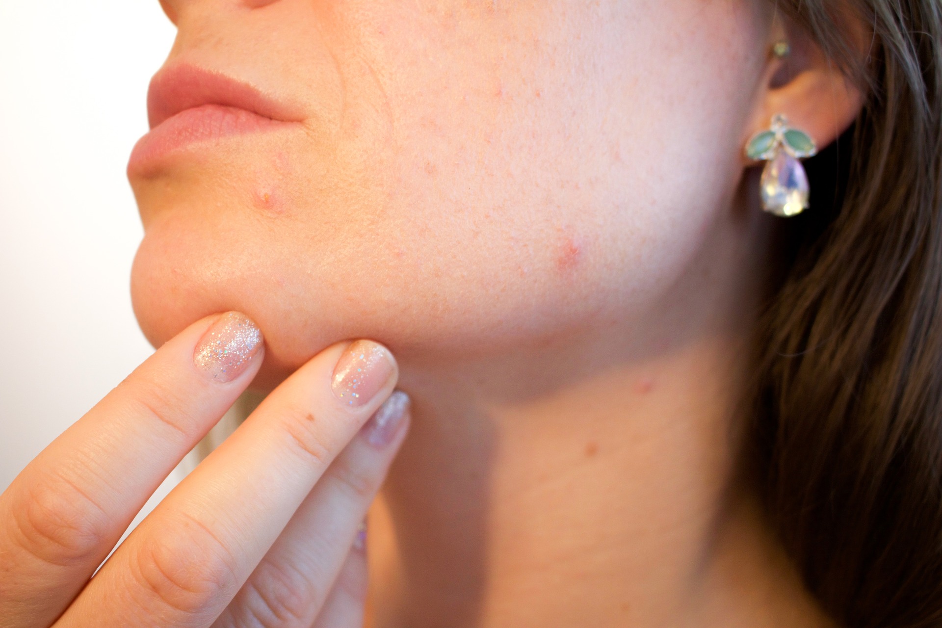 acne-1606765_1920.jpg Ακμή